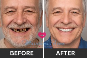 all on 4 dental implants before and after - Marielaina Perrone DDS - Las Vegas NV