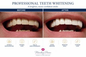 cosmetic dentistry teeth whiteing in henderson nv by marielaina perrone dds
